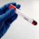 Analize specifice pentru sanatatea prostatei